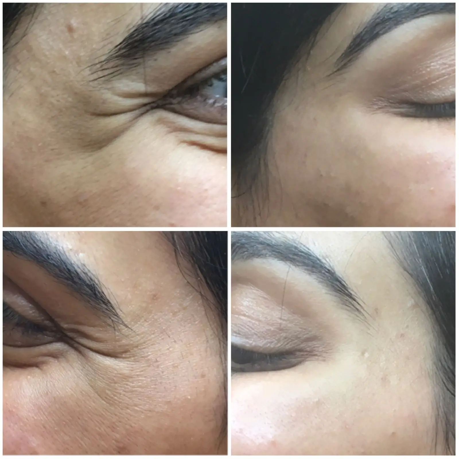 6611b58932dfeb47a20bc381_Botox-crowsfeet-dr.kumar-results-p-1600