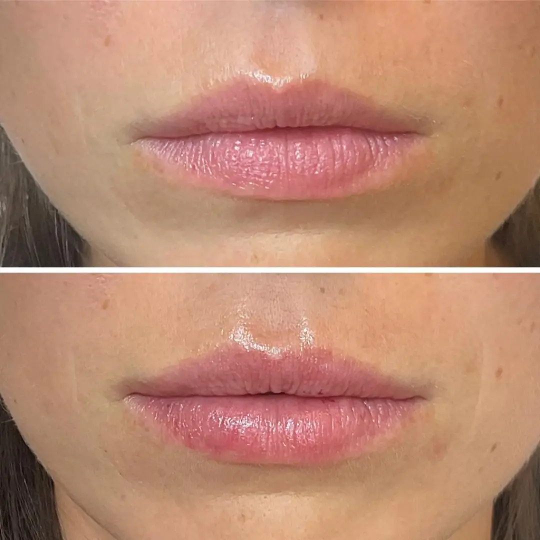 663c43553fc7ee0d975a18ec_lipfiller-before-&-after-result-drkumar (1)