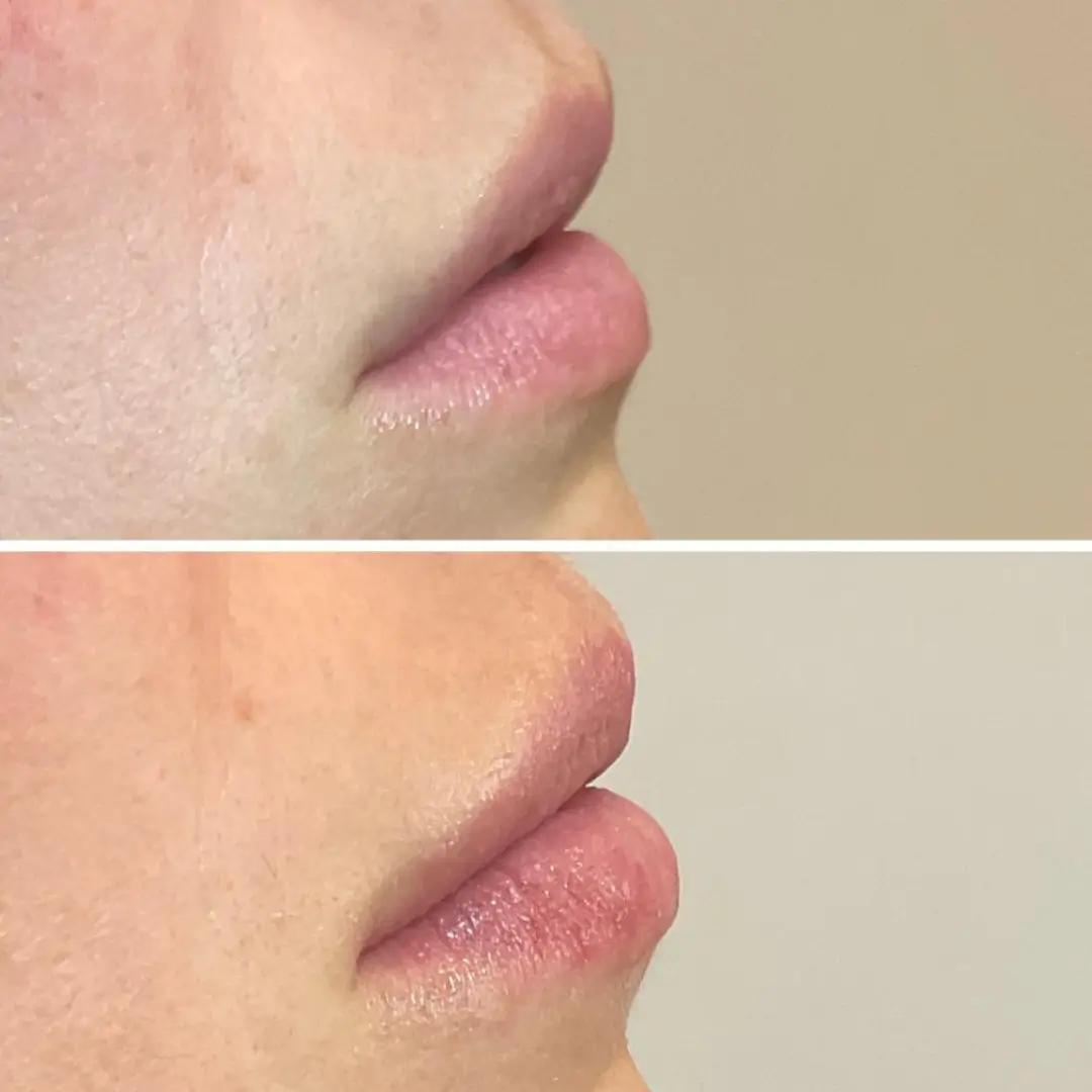 663c438e92e2d1a1bbdec36a_lipfiller-before-&-after-result-drkumar (2)