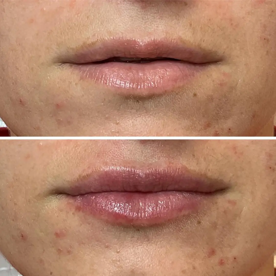663c43a613d9fff602237d6b_lipfiller-before-&-after-result-drkumar (3)