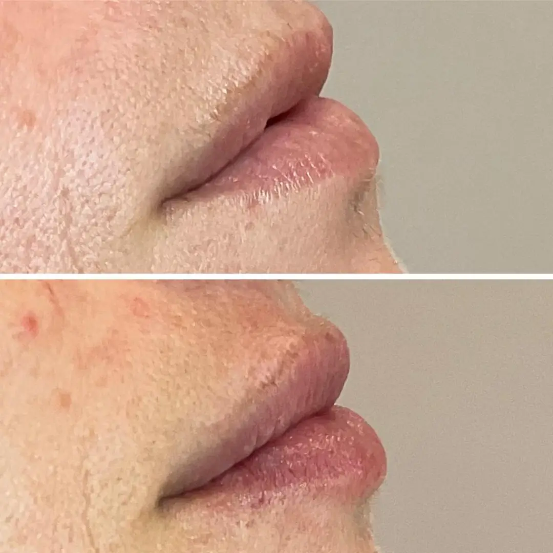 663c43cfe754cc2e1669e0d0_lipfiller-before-&-after-result-drkumar (4)