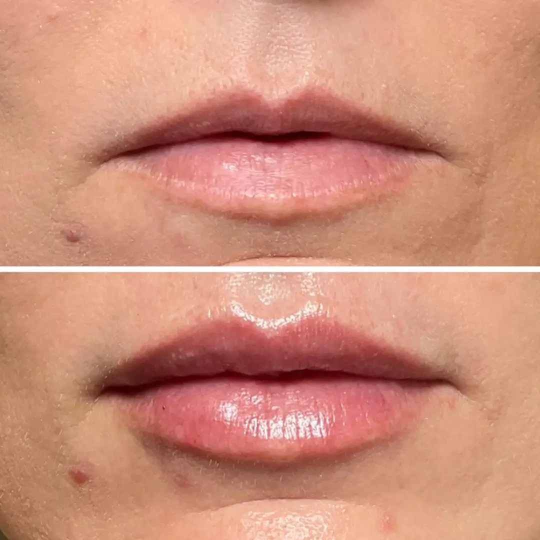 663c43f51b20ab216bc5829e_lipfiller-before-&-after-result-drkumar (5)