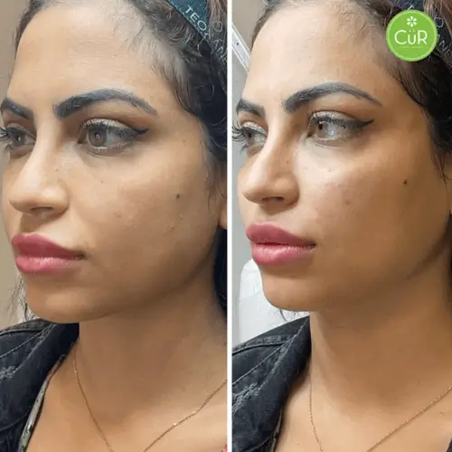 6655771ed718265a8146f31e_lateral-lift-injectables-results-cheeks-drkumar-vancouver-p-500