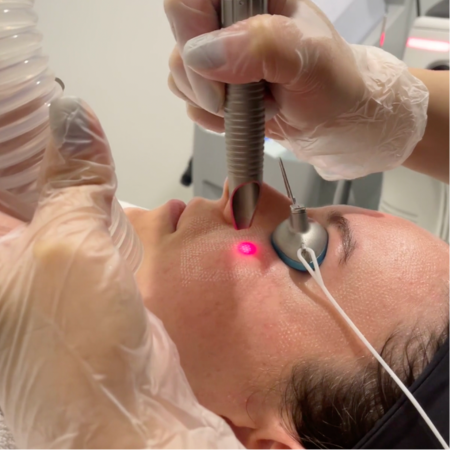 Microlaser peel image