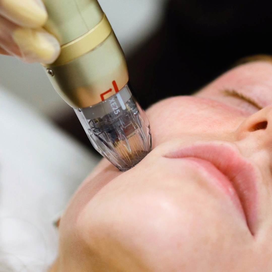 Client is receiving a SylfirmX RF microneedling facial treatment